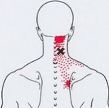 Карта триггеров: точки боли и точки напряжения мышц 