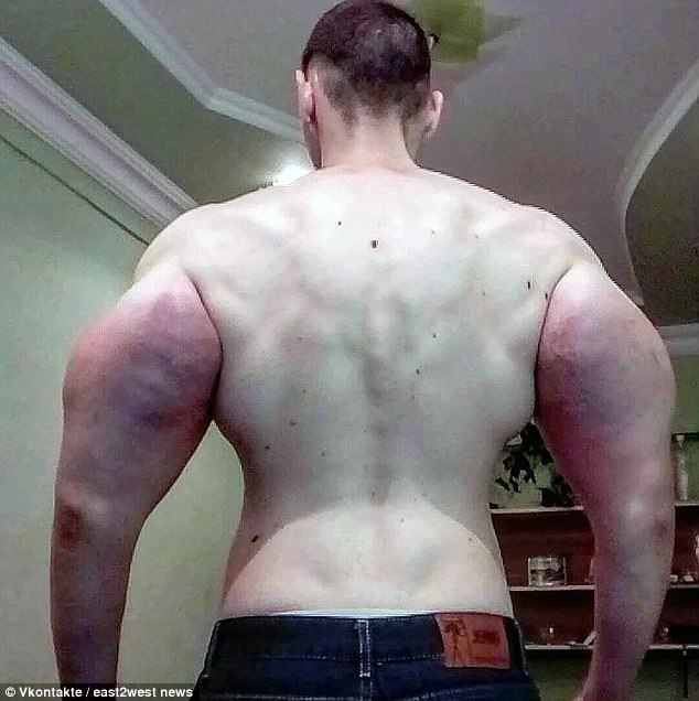 Synthol is made up of 85 per cent oil, 7.5 per cent lidocaine, and 7.5 per cent alcohol, and Tereshin has said he makes his from olive oil, lidocaine and benzyl alcohol